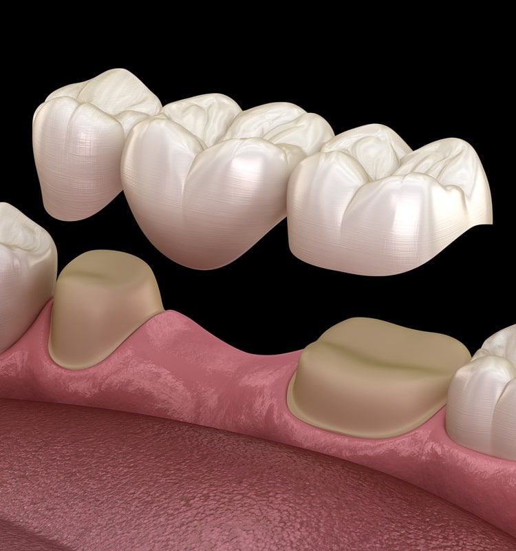 dental-bridges-in-pocosmiles-dental