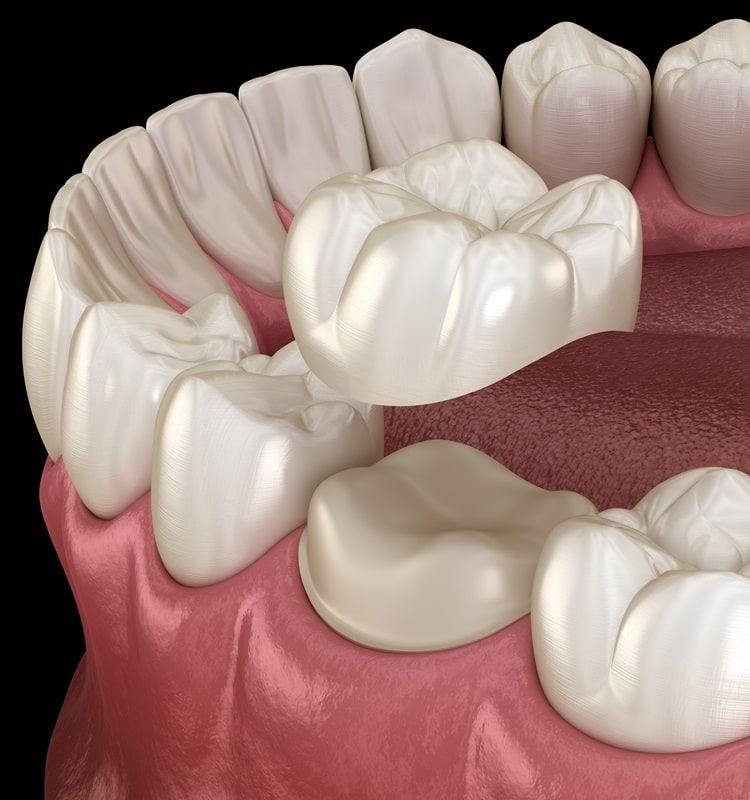 dental-crowns-in-pocosmiles-dental